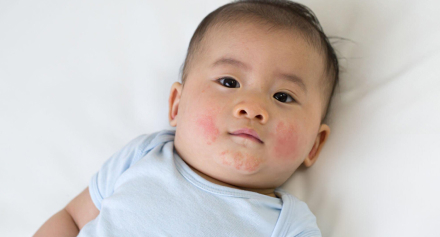 Image representing Acne in Children: A Complete Understanding